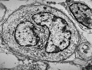 M,15y. | rhabdomyoma - lip